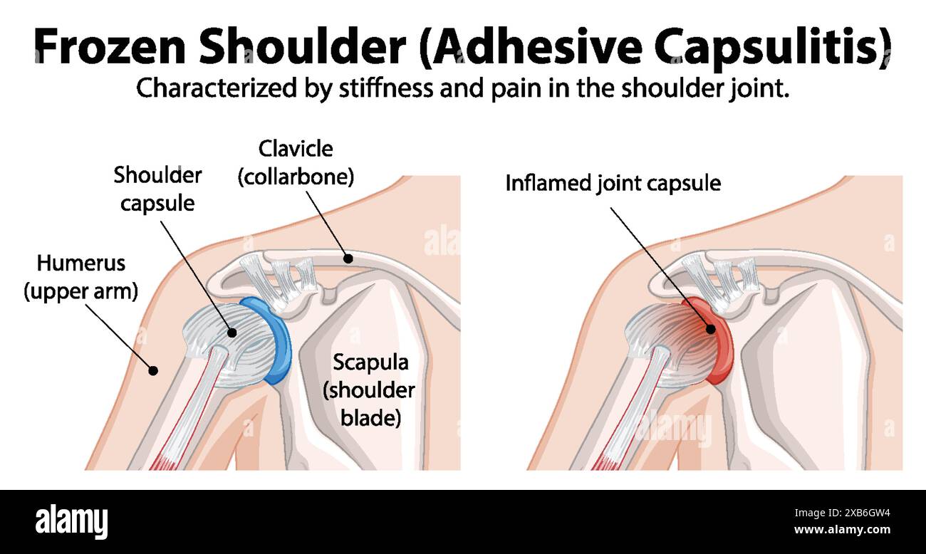 Diagram explaining adhesive capsulitis in shoulder joint Stock Vector Image & Art Alamy