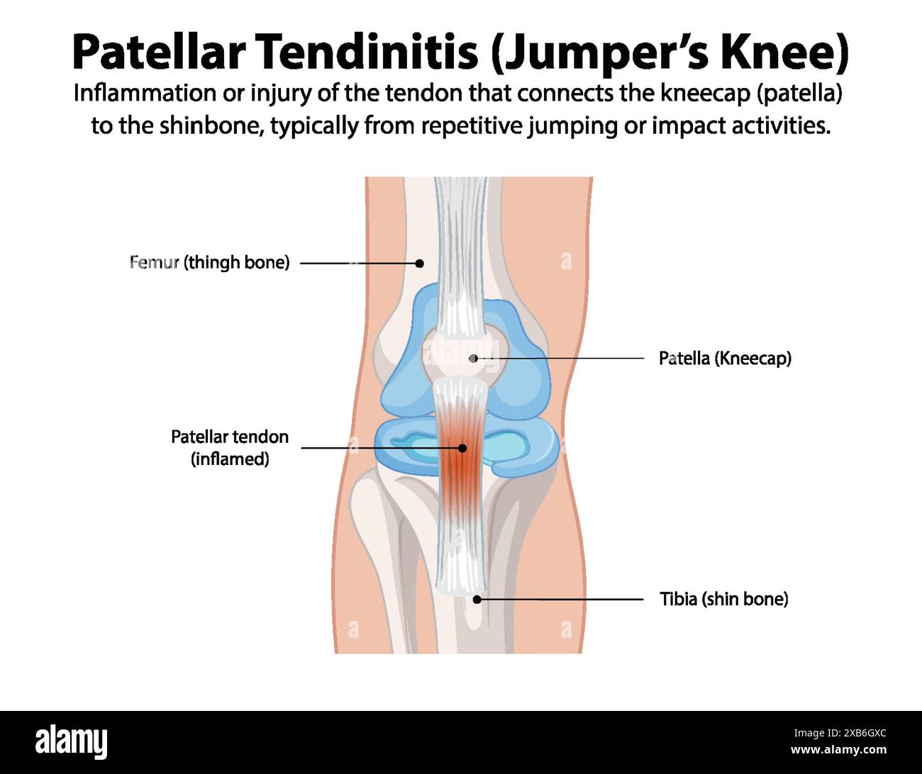 Inflammation of the patellar tendon from repetitive activities Stock ...