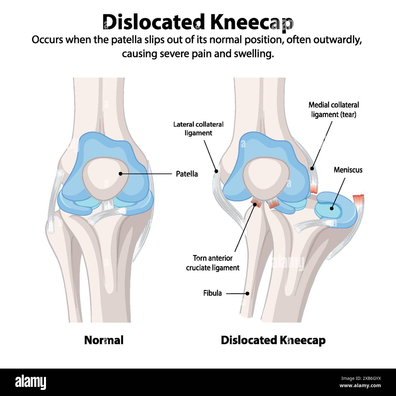 Dislocation Body Comparison of normal and dislocated kneecap Stock Vector Image & Art ...