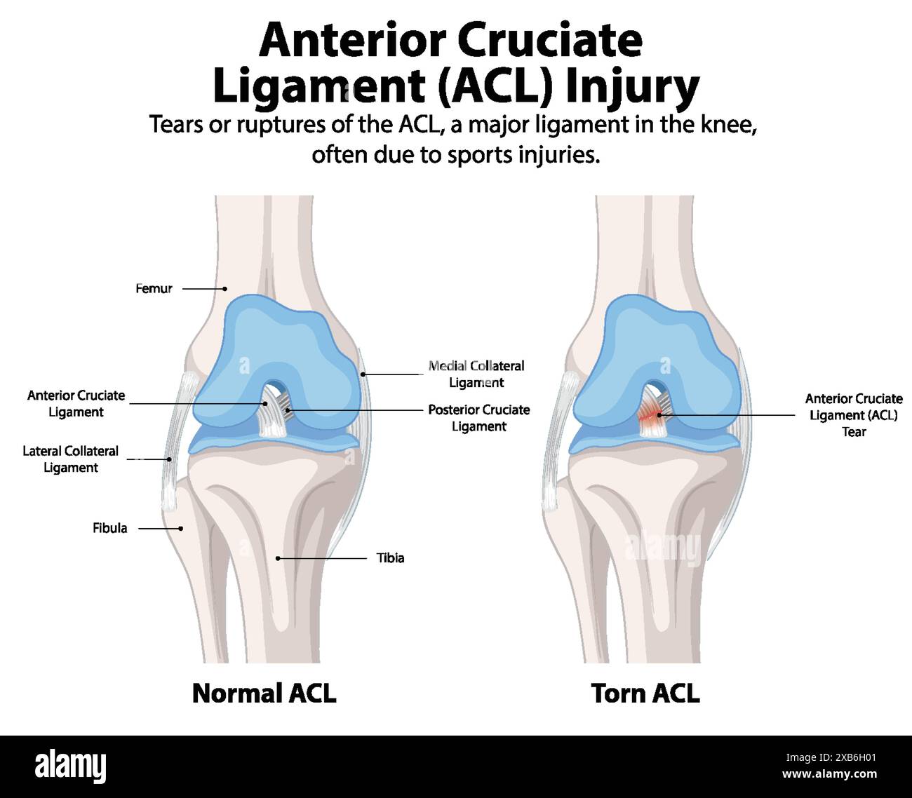 Posterior knee vector vectors hi res stock photography and images Alamy
