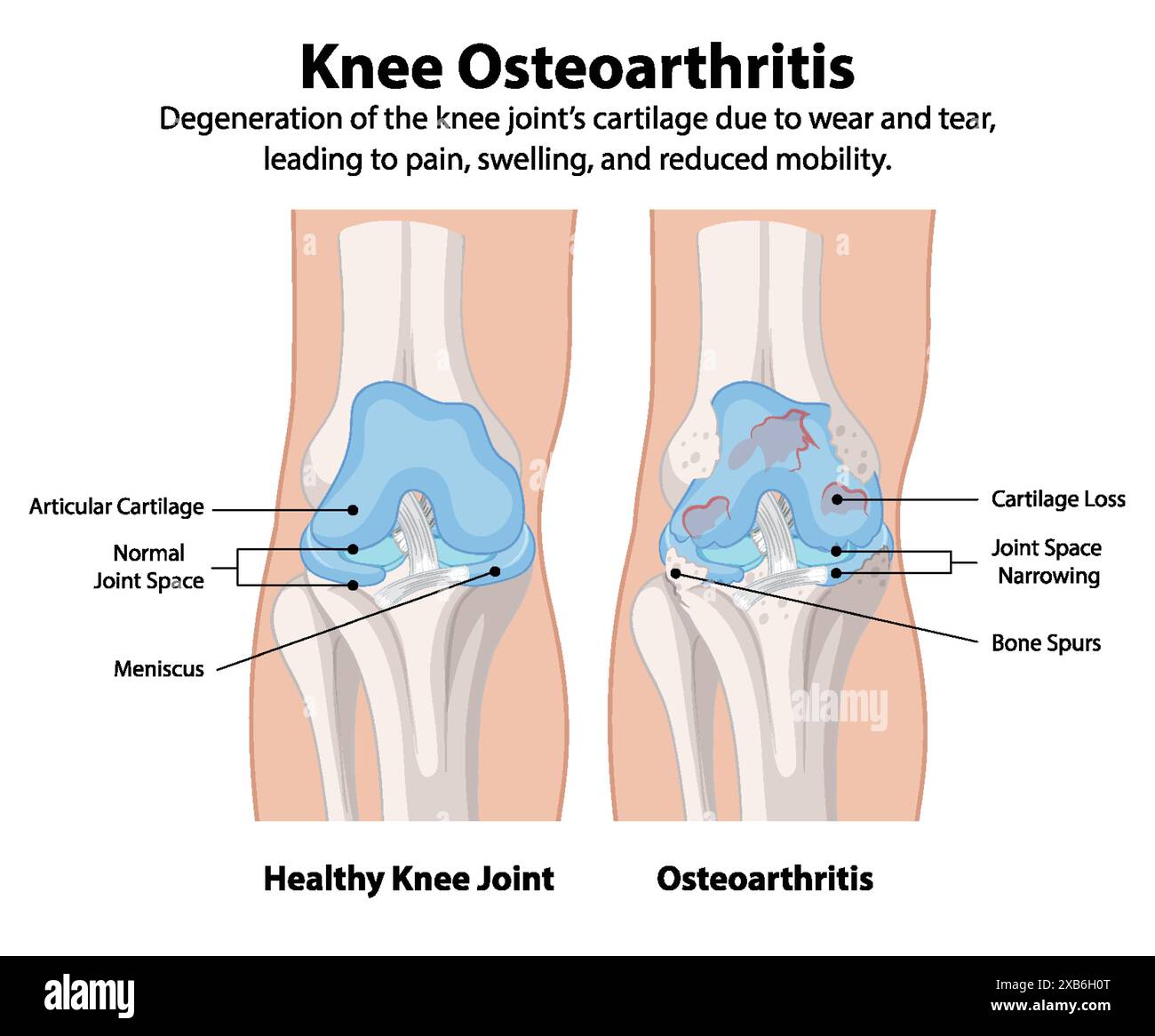 Healthy knee joint vs osteoarthritis knee joint Stock Vector Image ...