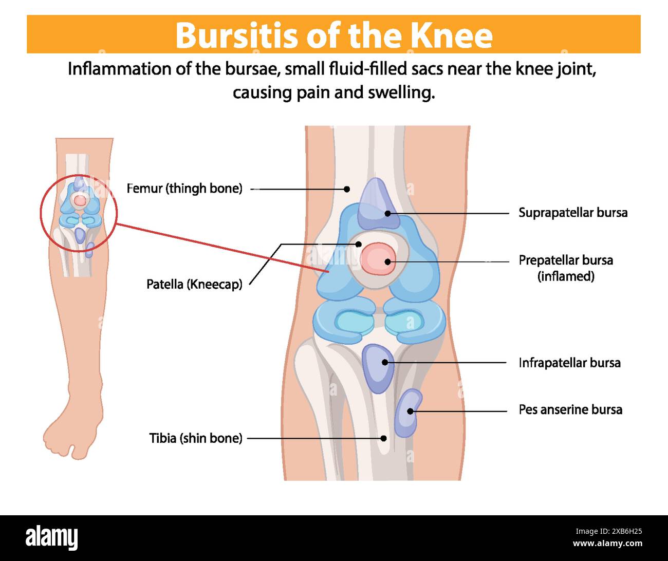 Diagram showing inflamed knee bursae and bones Stock Vector Image & Art ...