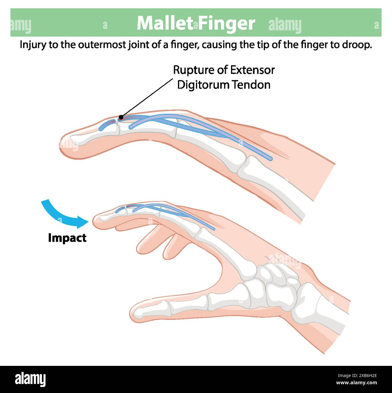 Diagram showing mallet finger injury and tendon rupture Stock Vector Image & Art Alamy