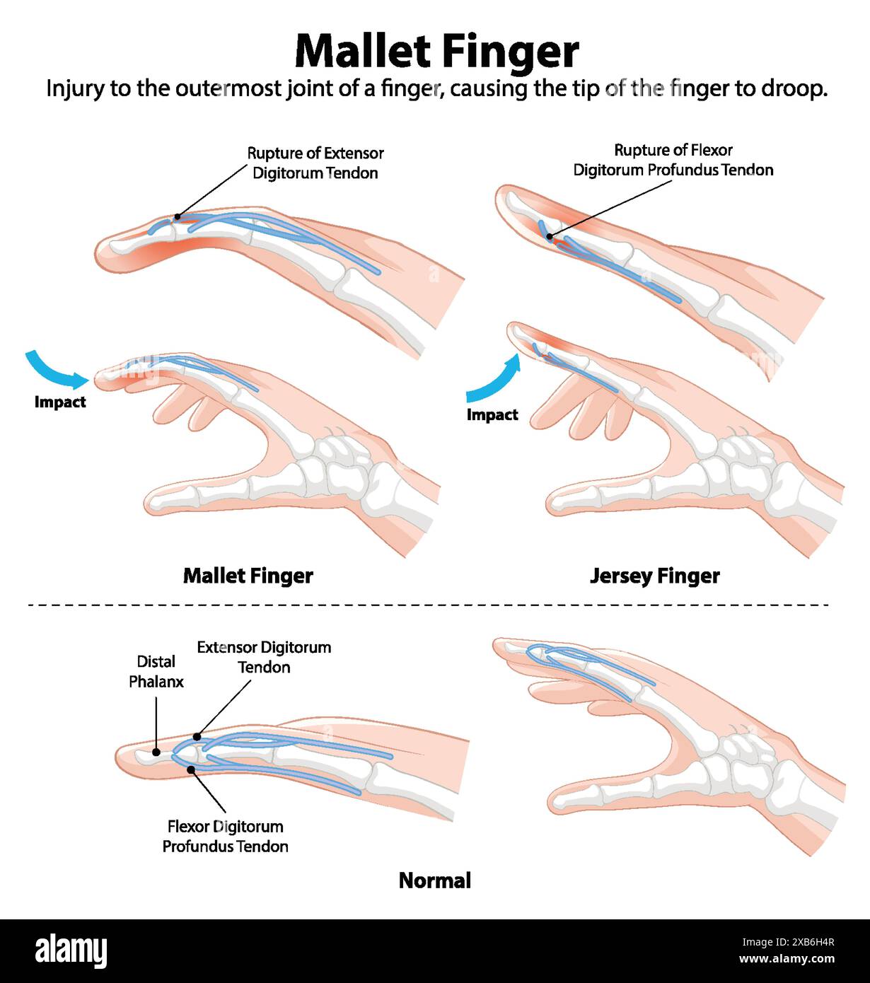 Diagram showing mallet and jersey finger injuries Stock Vector Image