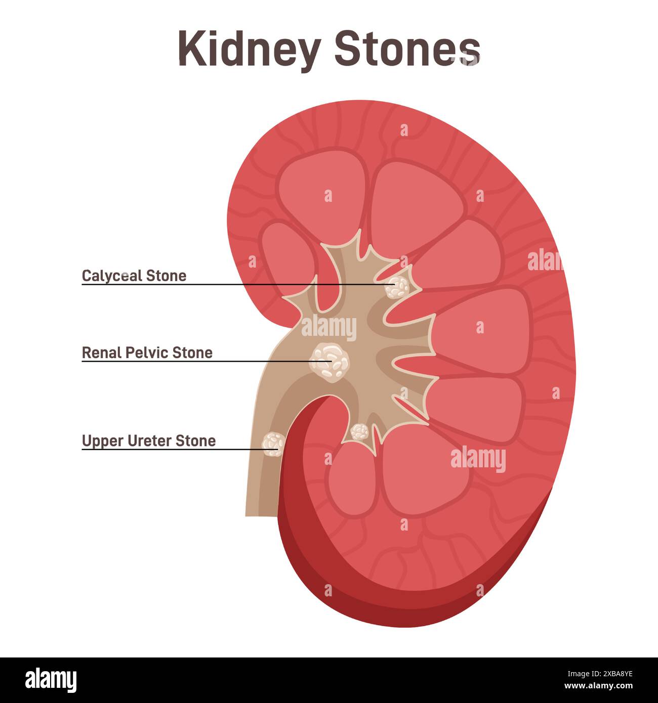 Anatomy Human Kidney stones Disease Anatomical Model Medical Teaching Supply