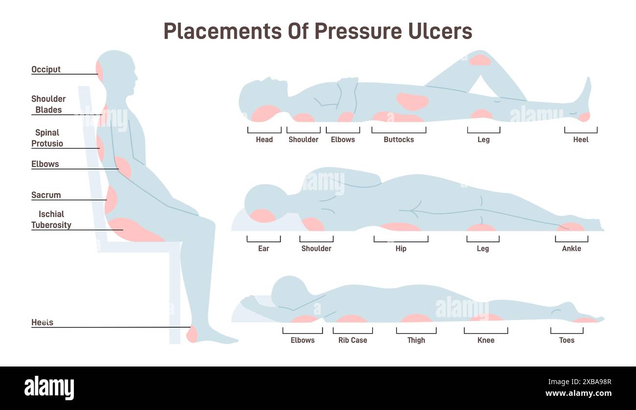 Pressure ulcers placements. Pressure sores areas on human body parts. Bedsore positions. Flat vector illustration. Stock Vector