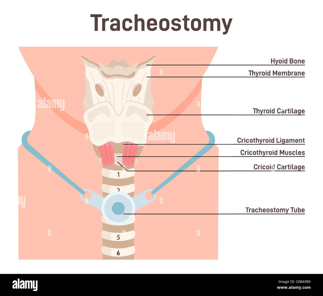 Tracheostomy. Tracheal surgery neutralise airway obstruction. Plastic cannula with inflatable cuff. Trachea anatomy. Flat vector illustration Stock Vector