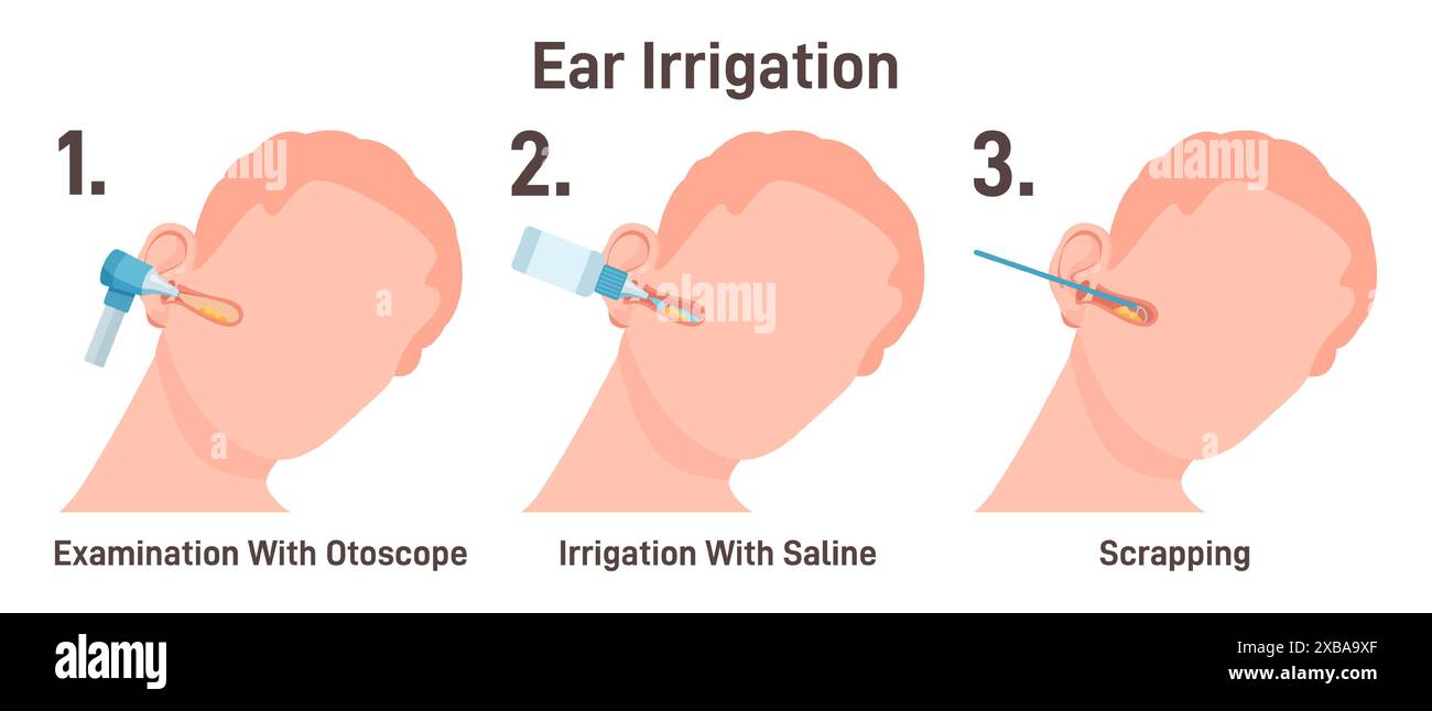 Pumping Ear ENT doctor irrigate ears. Doctor checking ear canals, removing earwax ...