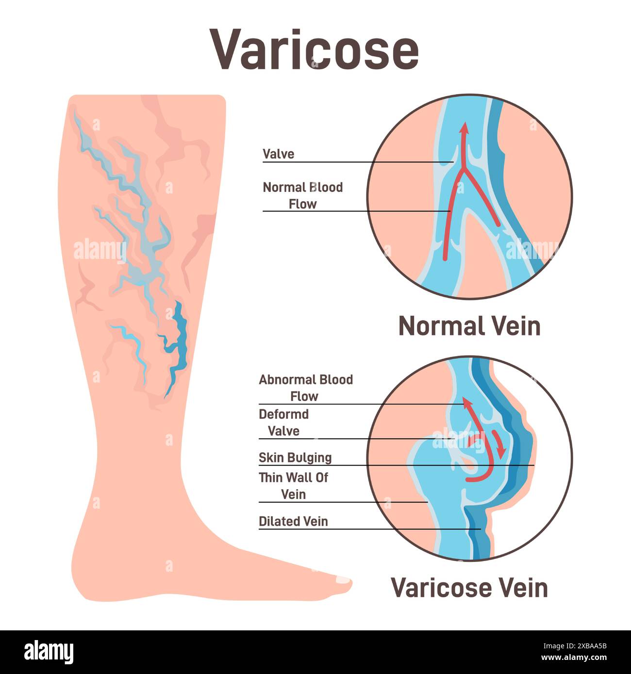 Image showcasing Varicoses. Anatomical diagram of varicose vein and normal healthy vein ...