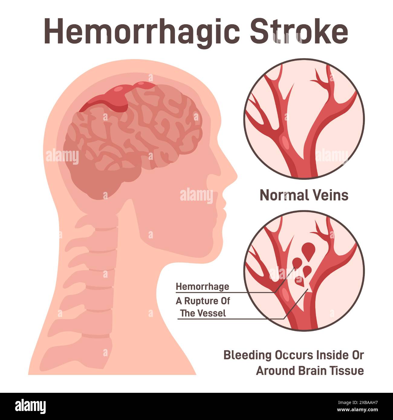 Hemorrhagic brain stroke concept. Hemorrhage in the brain, rupture of a blood vessel. Stroke and coronary disease, hemorrhage in the human head. Emergency medical care. Flat vector illustration Stock Vector