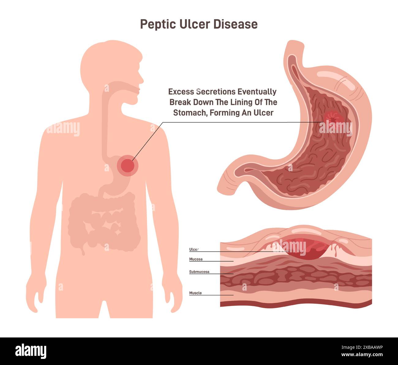 Peptic ulcer disease. Stomach wall with a sore on the lining. Digestive tract organ disorder. Flat vector illustration. Stock Vector