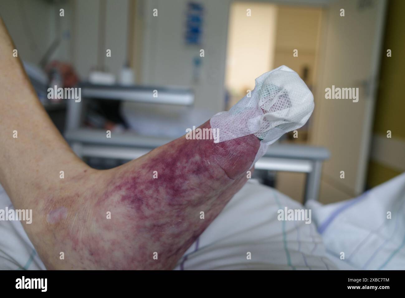 A patient with a foot with impaired blood circulation has a bandage on the toe Stock Photo