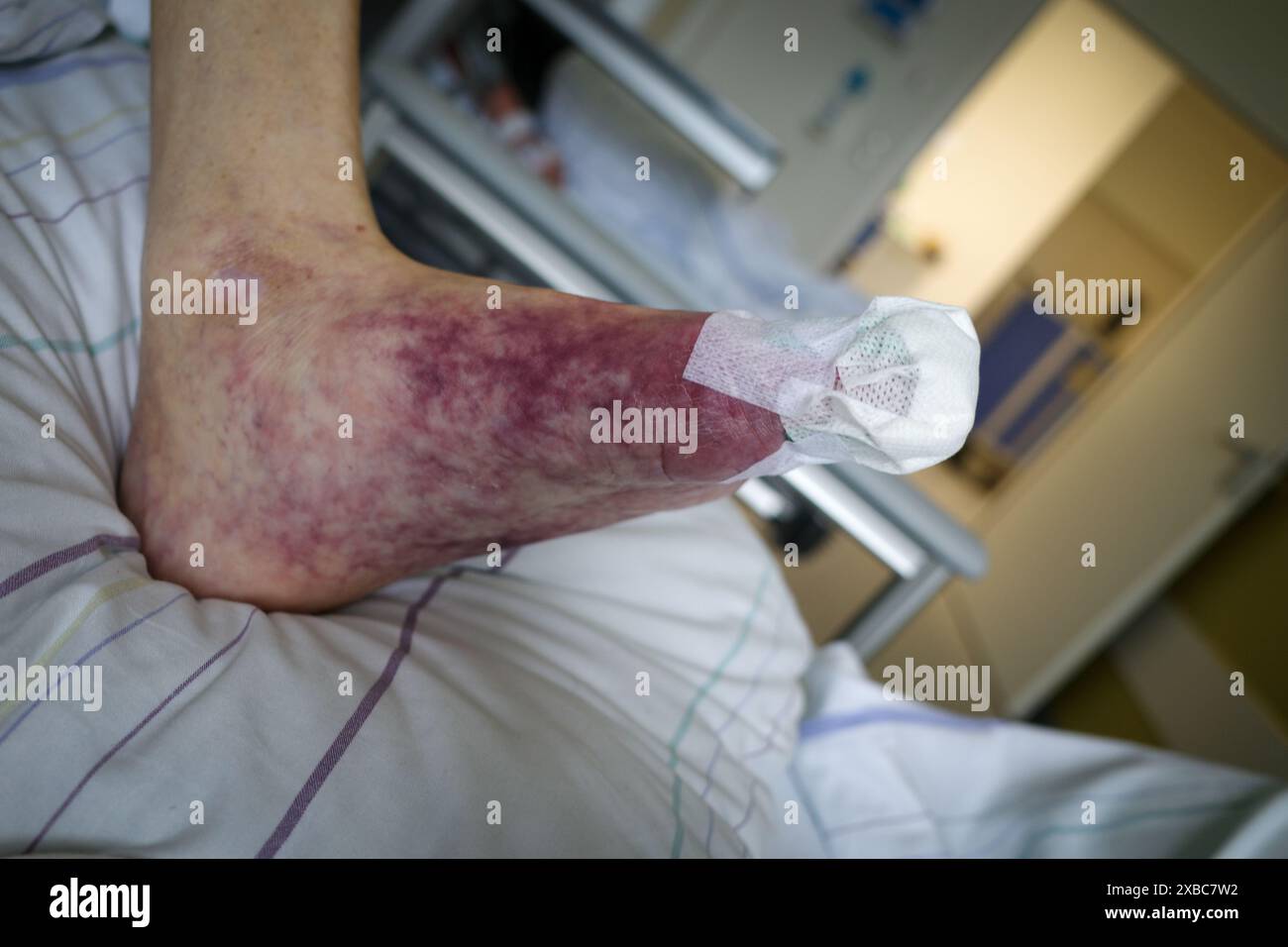 A patient with a foot with impaired blood circulation has a bandage on the toe Stock Photo