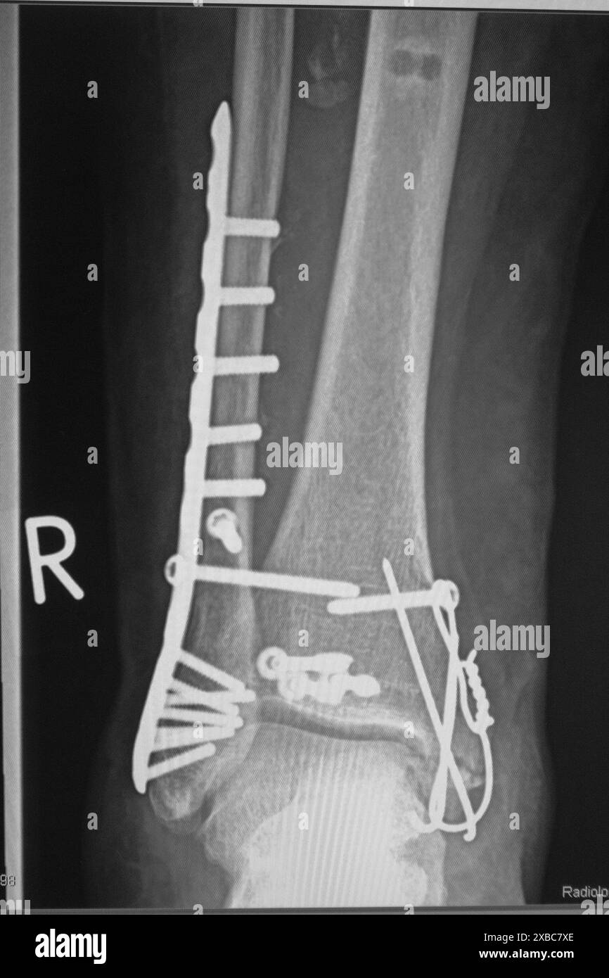an Xray shows an ankle fracture after surgery Stock Photo Alamy