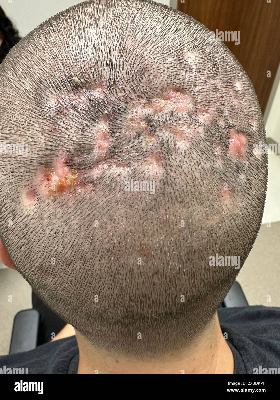scarring-and-alopecia-on-the-scalp-of-a-patient-with-dissecting