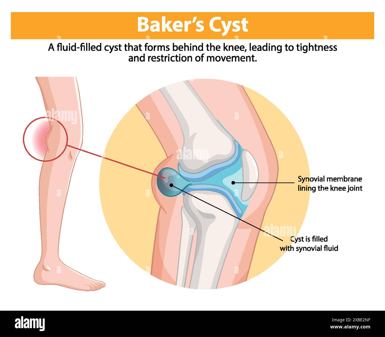 Illustration of a fluidfilled knee cyst Stock Vector Image & Art Alamy