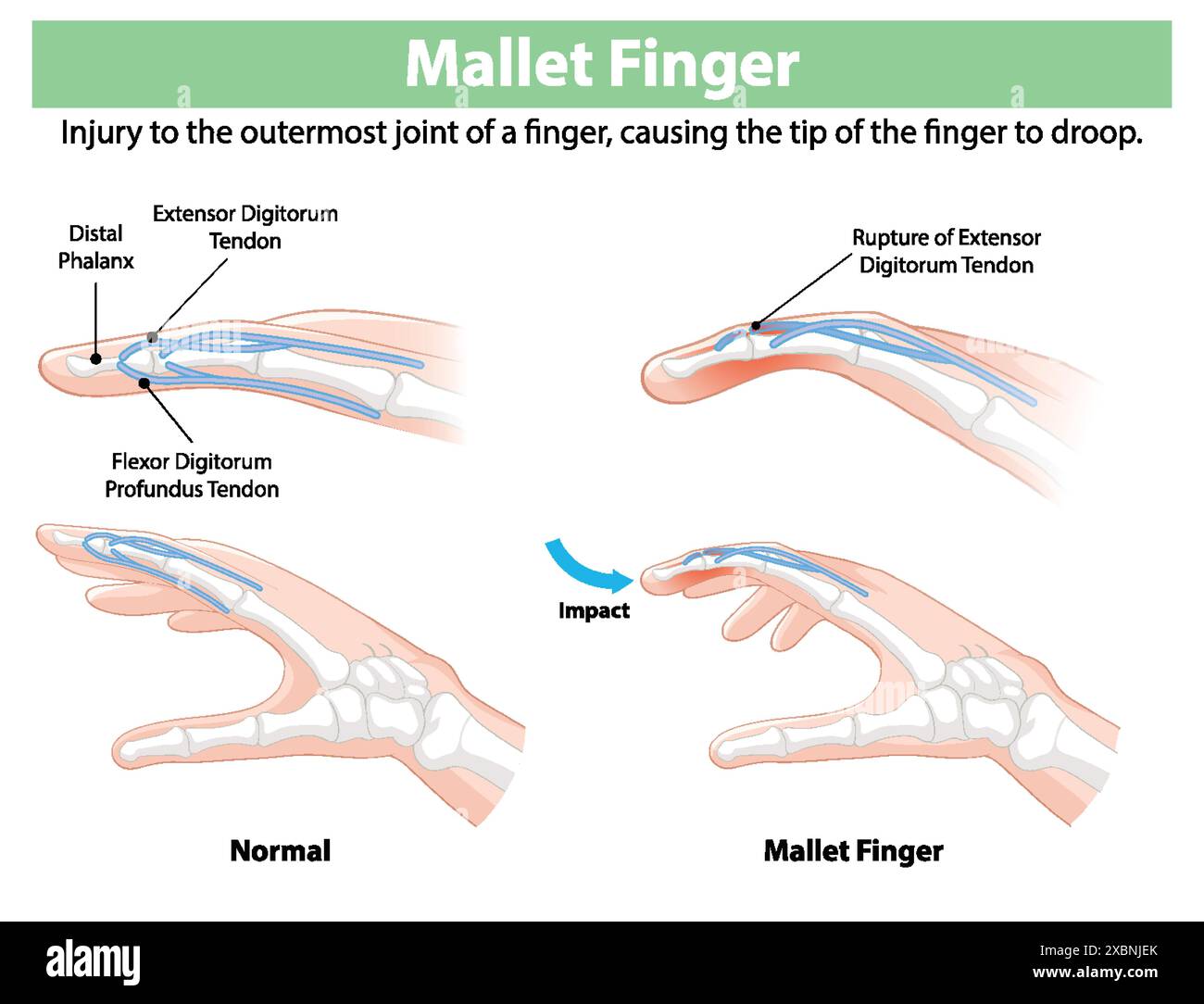 Diagram showing normal and mallet finger conditions Stock Vector Image