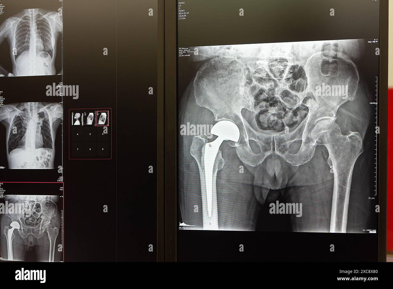 X-ray of hip joint endoprostheses on the monitor screen. Medicine ...