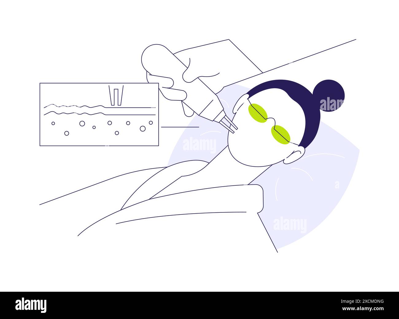 Laser peels abstract concept vector illustration Stock Vector Image ...