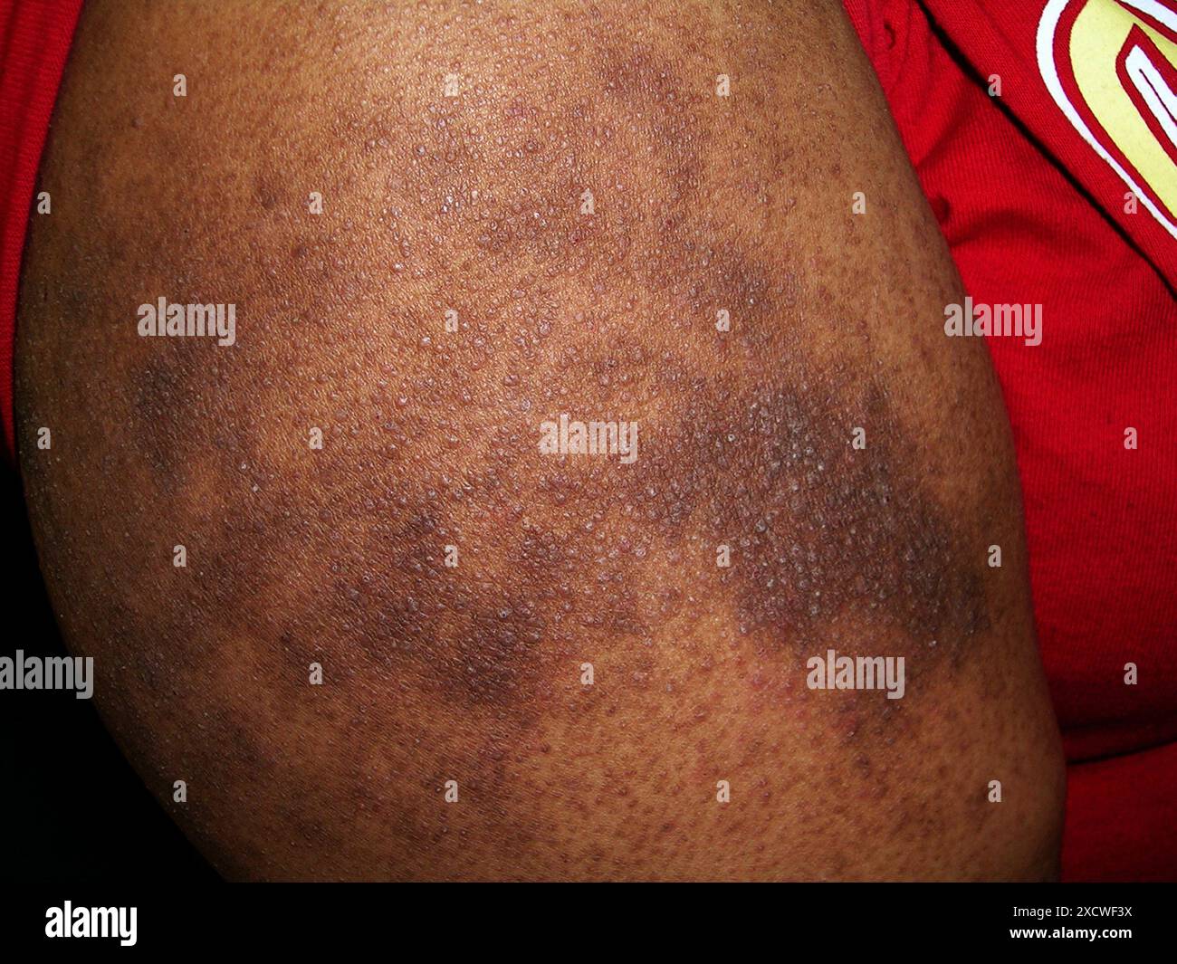 Papular eczema on the arm of an African American patient Also known as