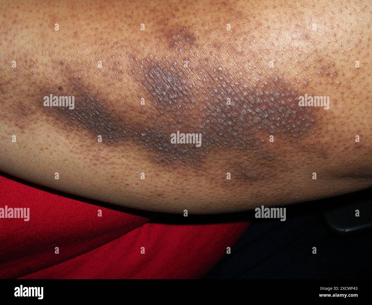 Papular eczema on the arm of an African American patient Also known as