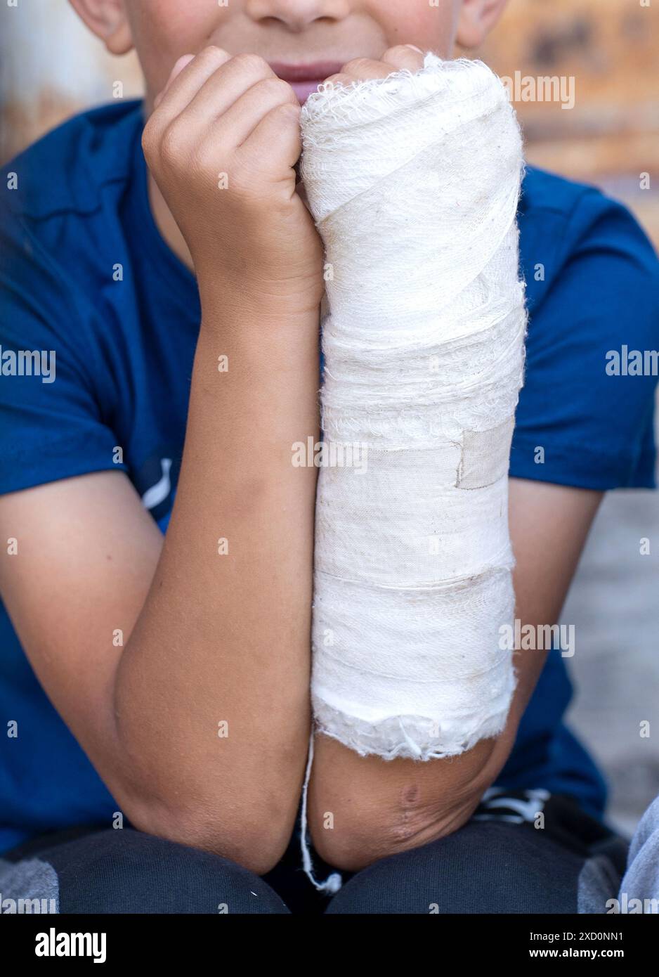 Contrasts of Healing. Close-Up of a Young Boy's Hands, One Healthy and One in a Cast. Stock Photo