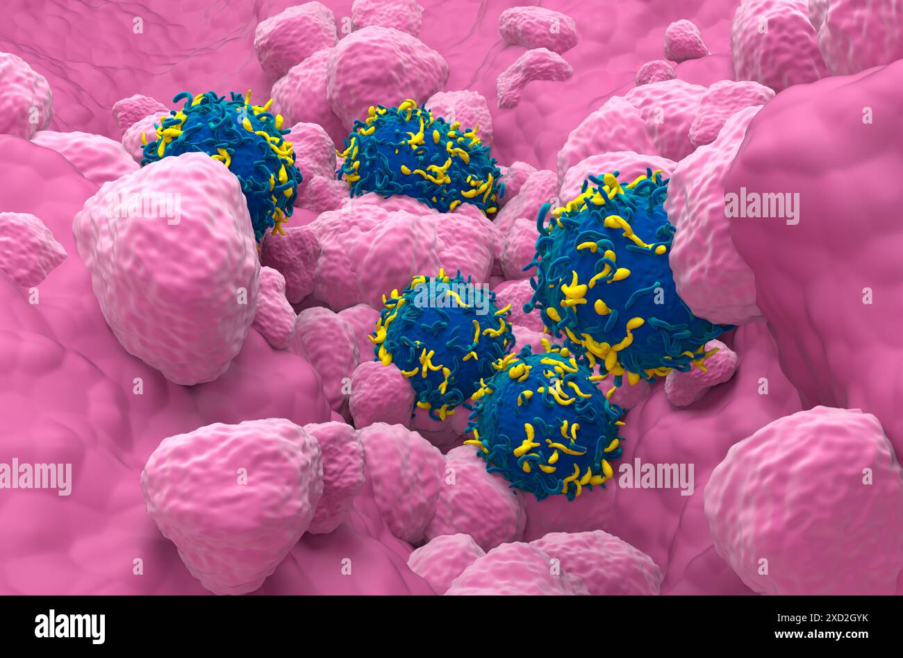 Squamous cell carcinoma of the lung hi-res stock photography and images ...