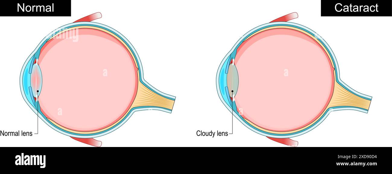 Cataract. Cross section of a human eye with Normal lens and Cloudy lens. Blurred vision. Eye health. Aging process in eye. Decrease in vision. Vector Stock Vector