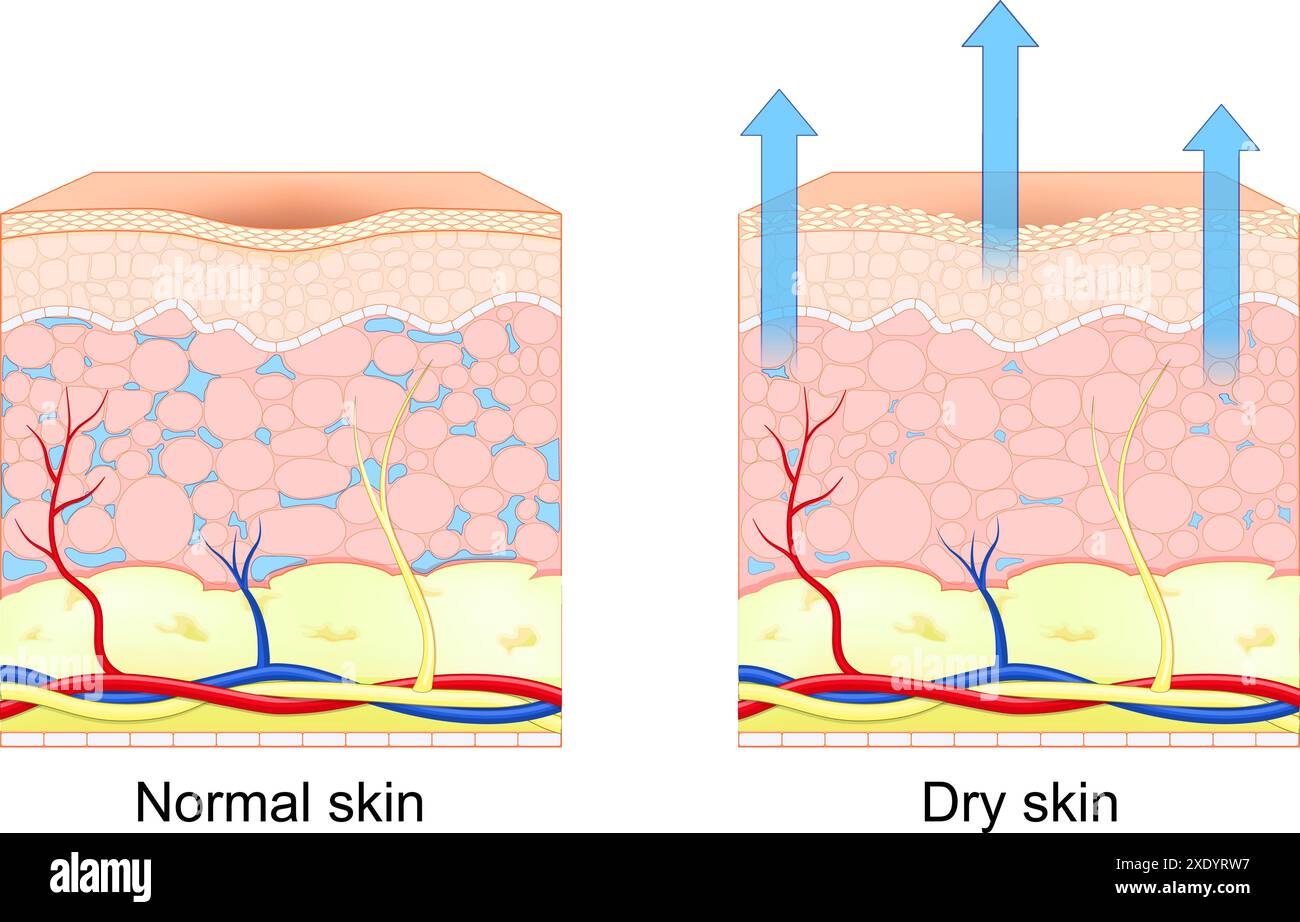 Dry and normal skin. Cross section of human skin. Loss of moisture in human skin. Vector illustration Stock Vector