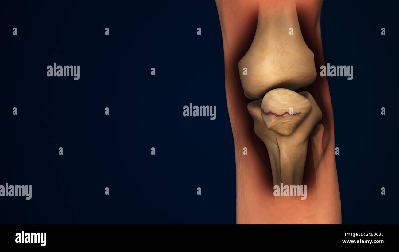 Leg bone Fracture or inflammation of human knee cap Stock Photo