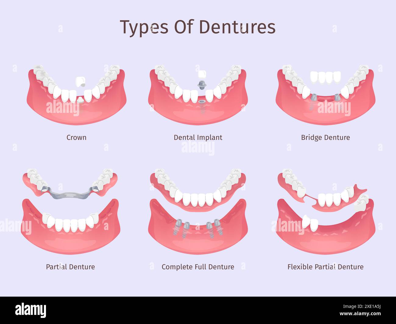 Dentures types. Tooth biting restorations dental care prosthesis teeth