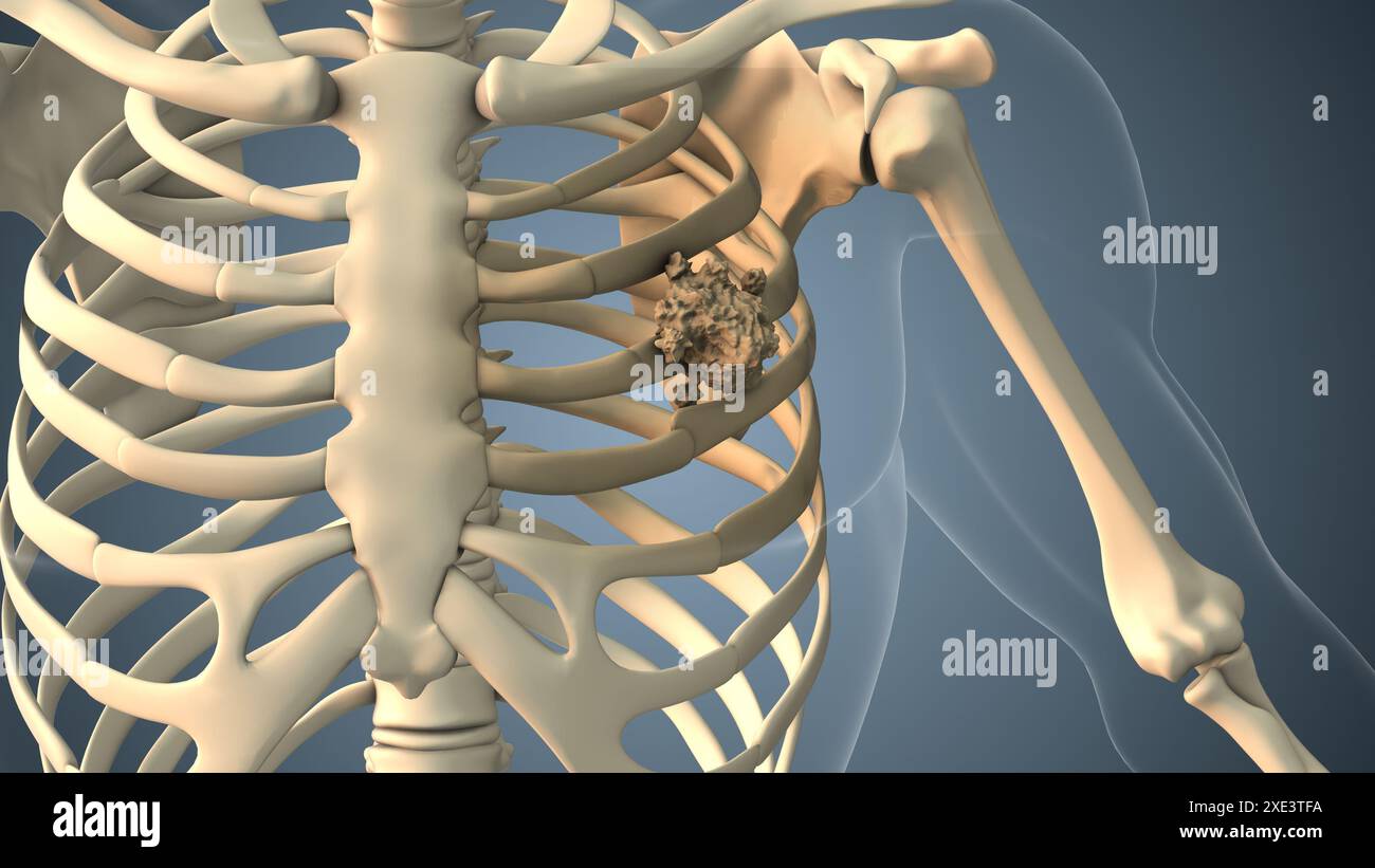 Cancer spreading along a rib bone Stock Photo - Alamy