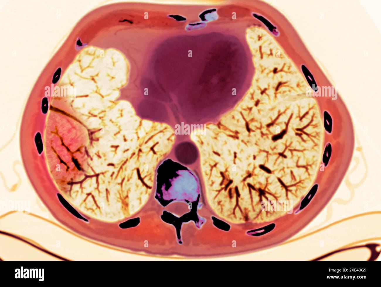 Coloured computed tomography (CT) scan of the chest of a 60 year old ...