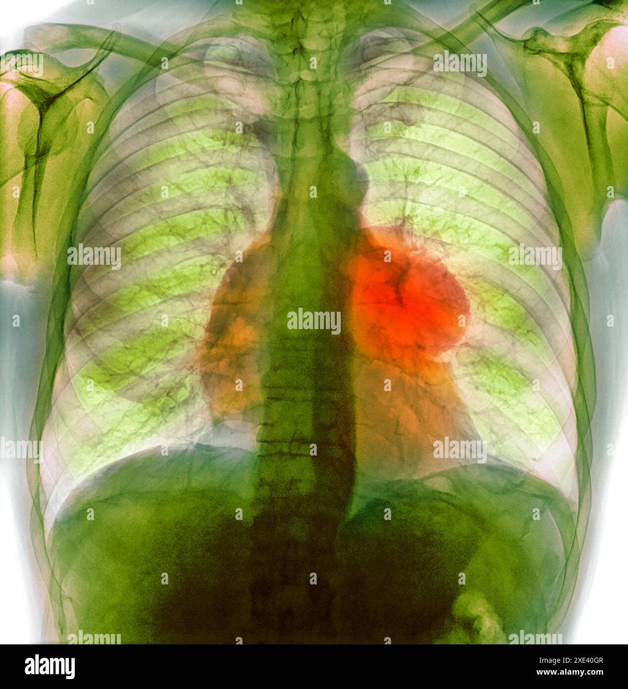 Coloured X-ray of a mediastinal mass (red) in the chest of a 53 year ...