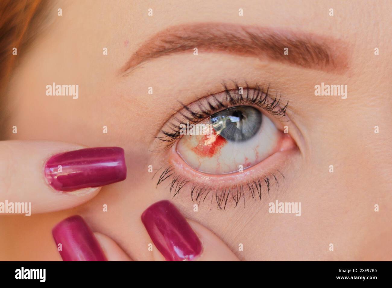 Blue eye on the right side of a woman, without identifying the person, with ocular hemorrhage, highlighting the red bleeding in this eye. Stock Photo