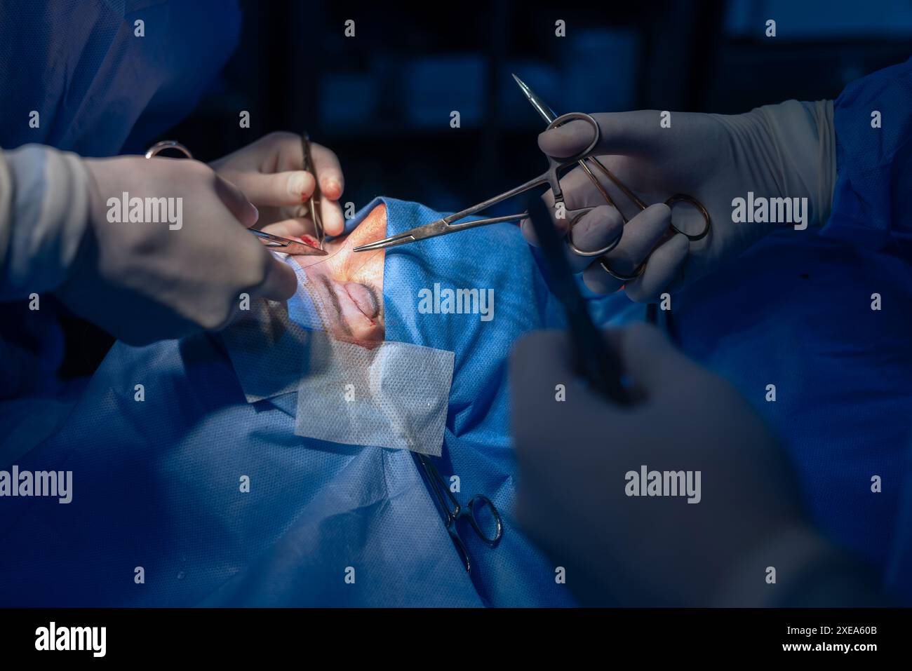 Blepharoplasty, plastic surgery to correct defects of the eyelids and eyes to aesthetically modify the eye area. removal of fat deposits, in a medical Stock Photo