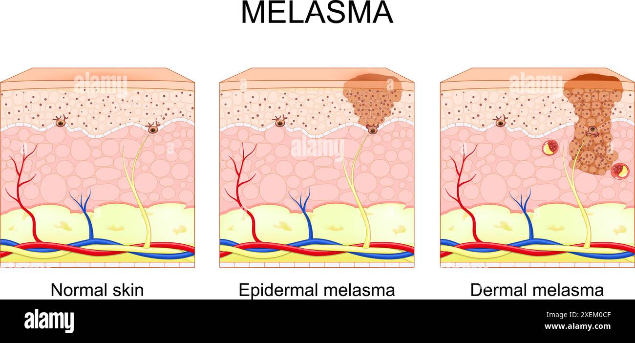 Melasma. Types of chloasma faciei. Cross section of human skin with Hyperpigmentation. Dermal and Epidermal melasma. Mask of pregnancy. Vector illustr Stock Vector