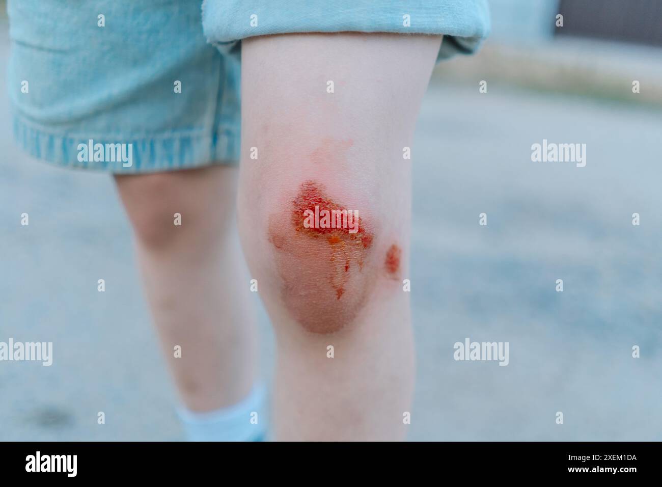 Skin scrape knee child hi-res stock photography and images - Alamy