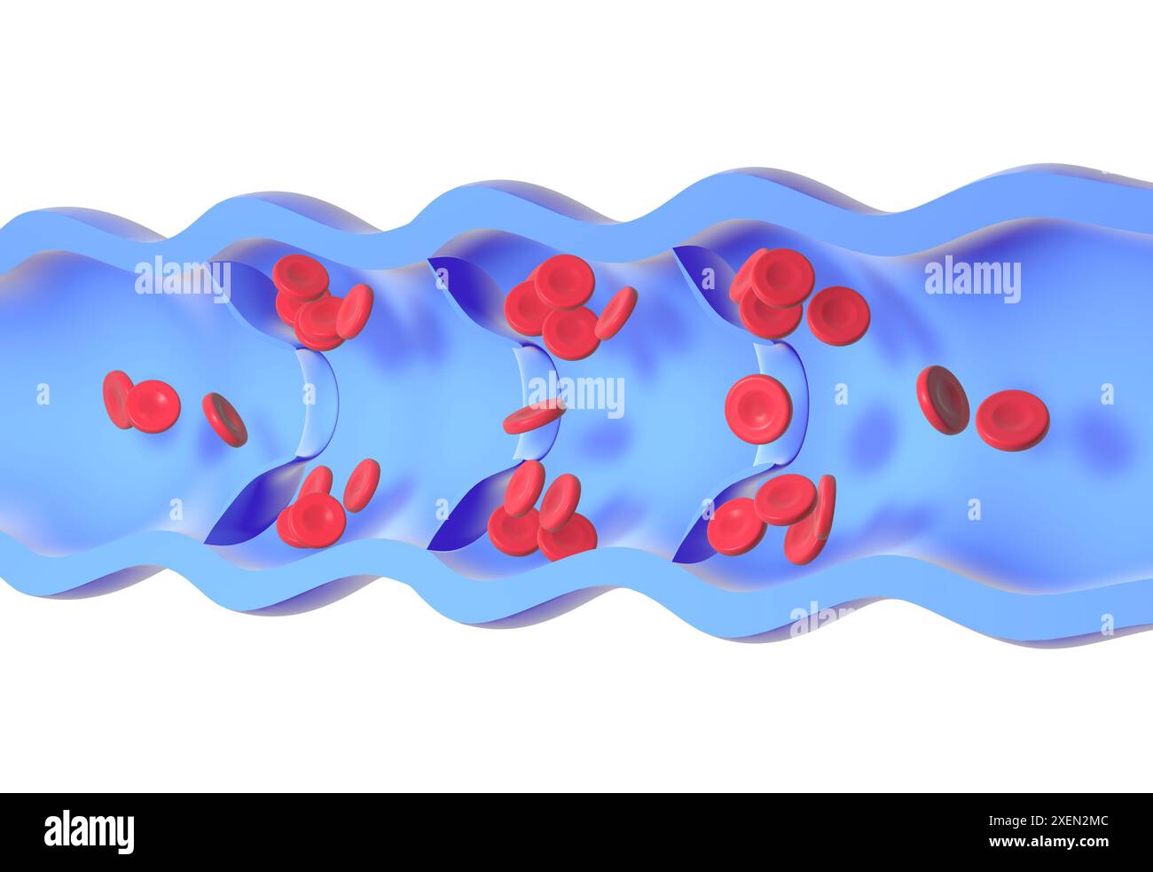 Anatomical 3d animation of a diseased and incompetent vein. Valves malfunction, accumulating red blood cells in the walls, causing varicose veins. Stock Photo