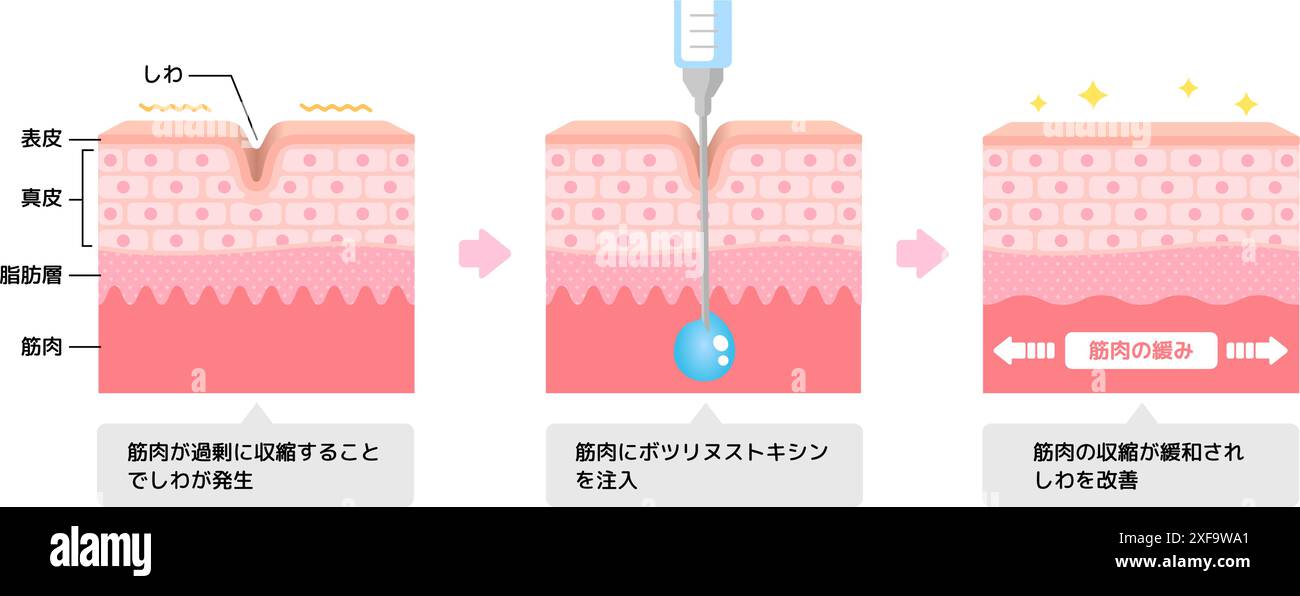 Roxcin Injection Mechanism of wrinkle improvement with botulinum toxin injection Stock ...