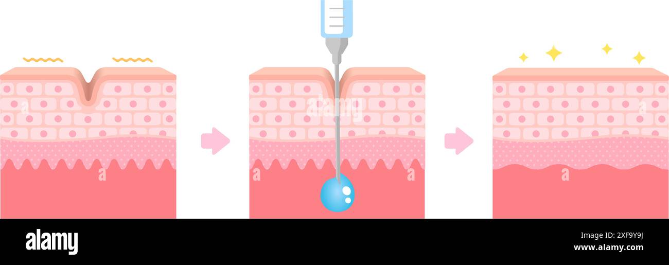 Roxcin Injection Mechanism of wrinkle improvement with botulinum toxin injection Stock ...