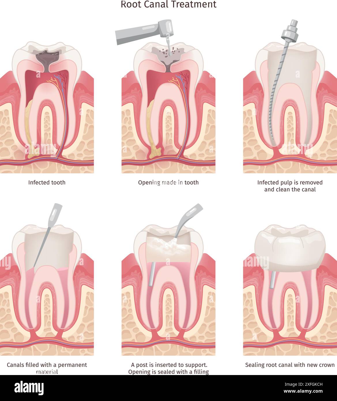 Root canal treatment. Tooth canal rooth filling endodontic procedure