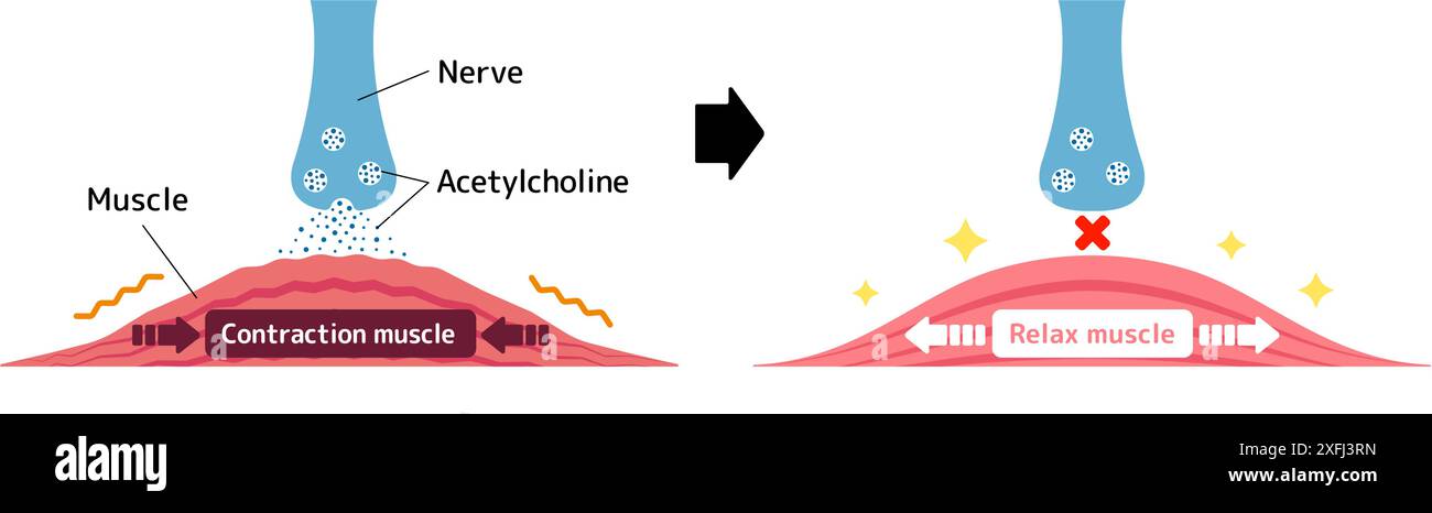 Mechanism of muscle relaxation by Botox. Vector illustration. Stock Vector