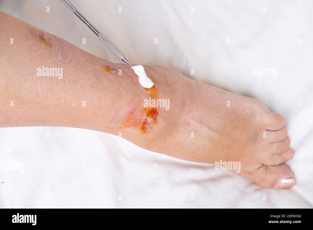 doctor providing medical care to heal burn wound on leg of adult female ...