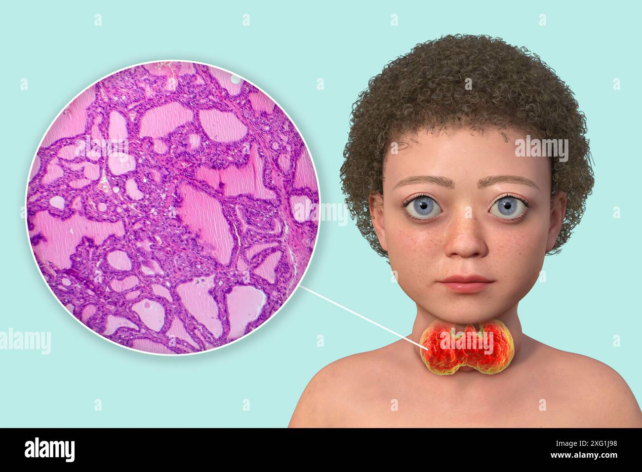 Illustration of a child with Graves' disease and a closeup of the