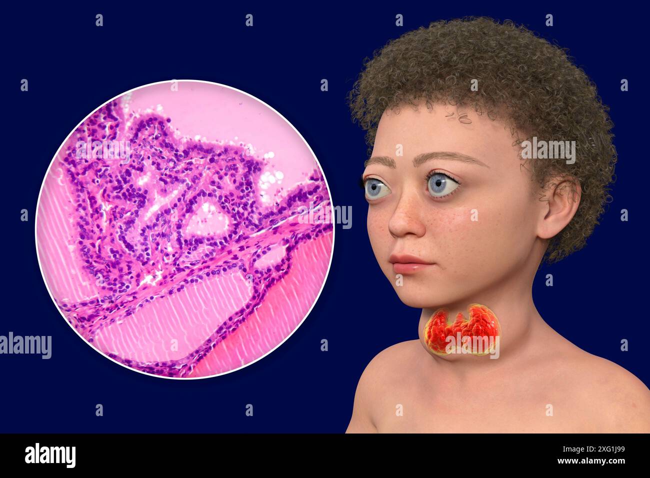 Illustration of a child with Graves' disease and a closeup of the