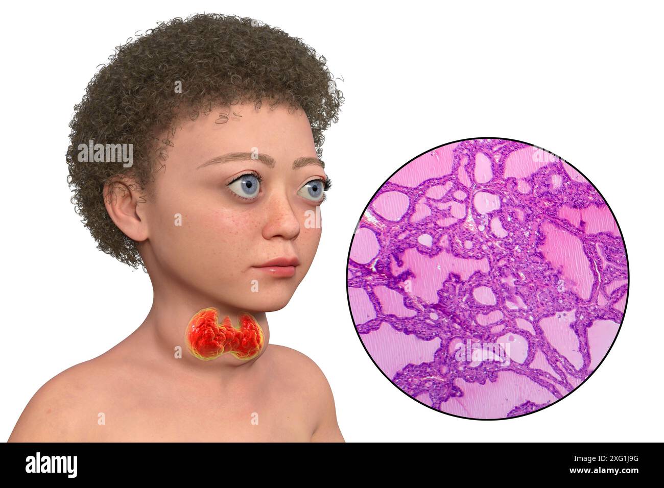 Illustration of a child with Graves' disease and a close-up of the affected thyroid tissue. Graves' disease can cause an enlarged thyroid gland (goitre, base of neck) to develop, and can cause abnormal protrusion of the eyes (exophthalmos). Graves' disease is an autoimmune condition in which antibodies are produced which cause the thyroid gland to produce excessive hormones. Stock Photo