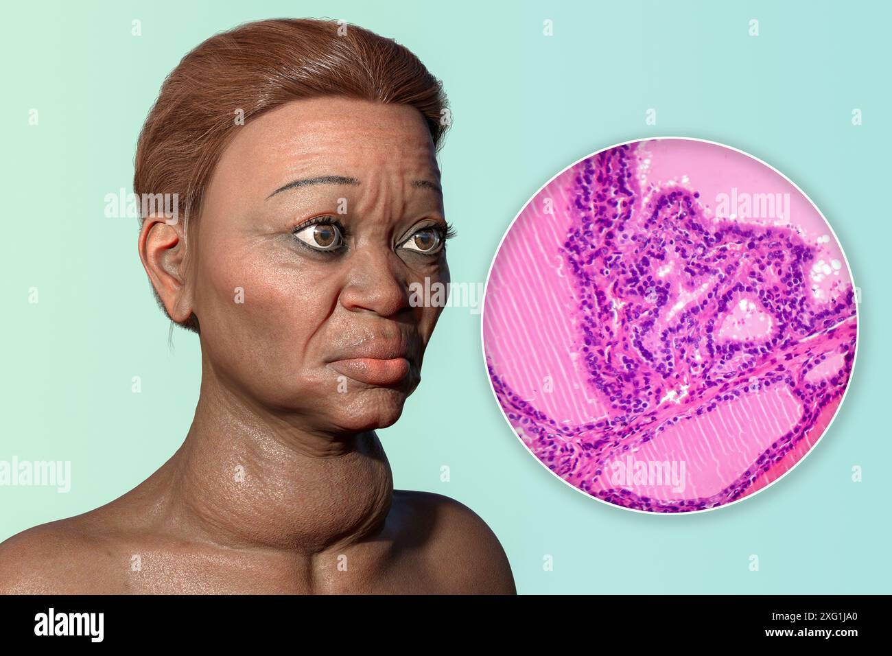 Illustration of a woman with Graves' disease and a closeup of the
