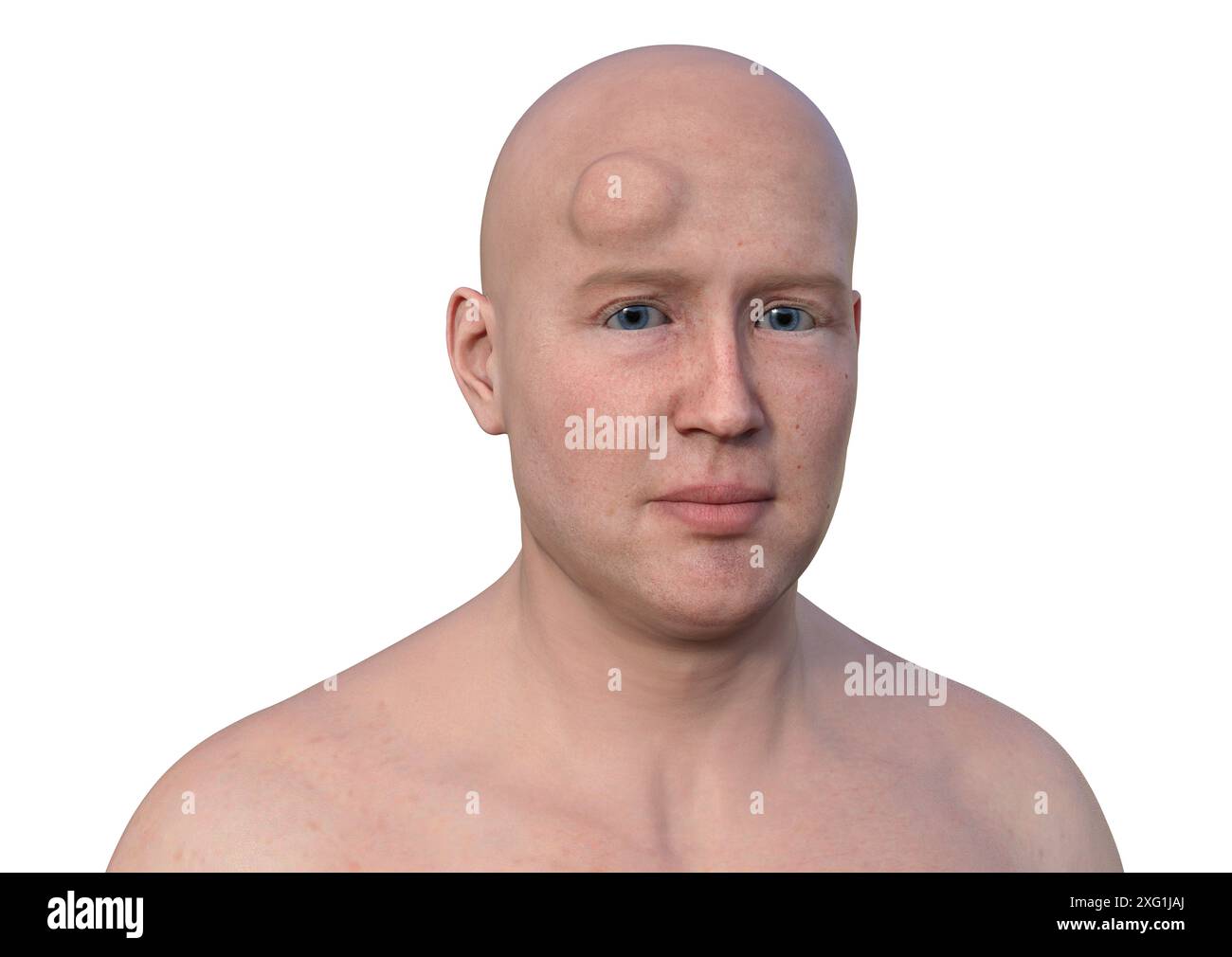 Illustration of a man with a lipoma on his forehead. Lipomas are benign ...