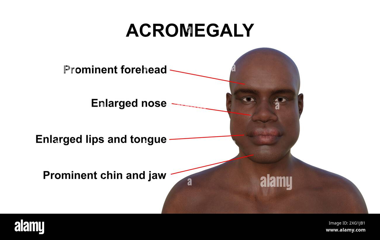 Illustration Of A Man With Acromegaly With Typical Symptoms Labelled Illustration Of A Man With Acromegaly With Typical Symptoms Labelled This Is A Condition Causing An Increase In The Size Of The Hands And Face Due To The Overproduction Of Somatotrophin Human Growth Hormone It Is Typically A Result Of A Benign Tumour Adenoma Forming On The Pituitary Gland 2XG1JB1